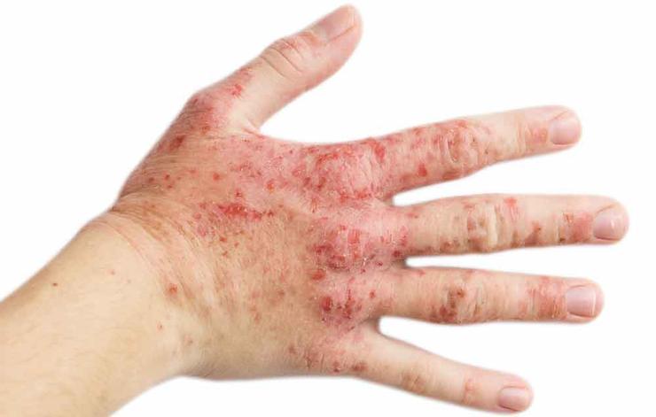 allergic