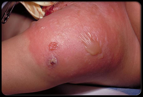 202staph-infection-s5-photo-of-staphylococcal-infection-from-smallpox-vaccination