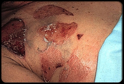 204staph-infection-s11-photo-of-staphylococcal-scalded-skin-syndrome