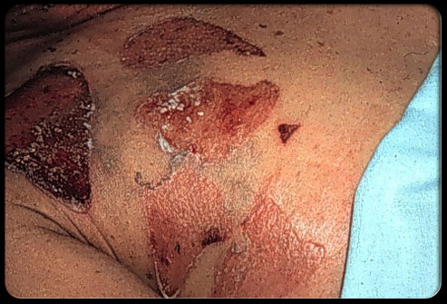 204staph-infection-s11-photo-of-staphylococcal-scalded-skin-syndrome
