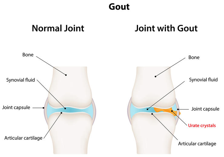 shutterstock 181514690 gout joshya