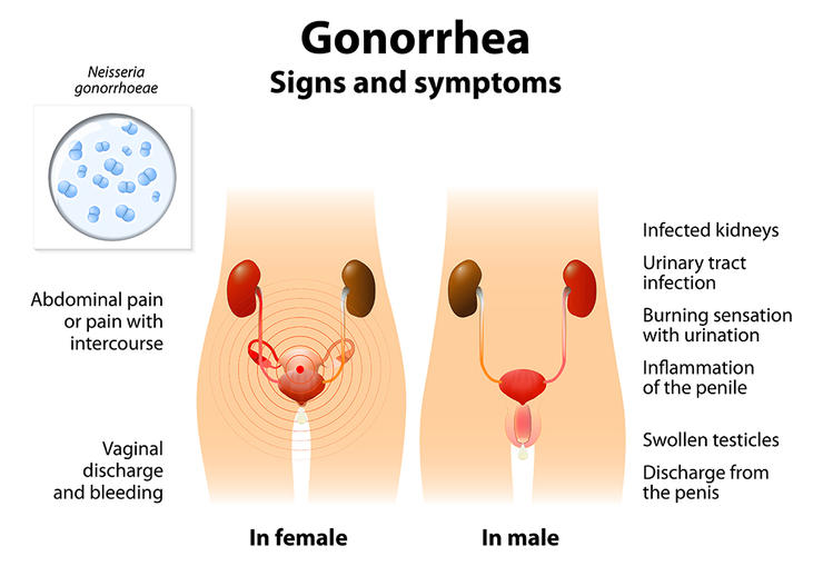shutterstock 371672449 gonorrhea designua