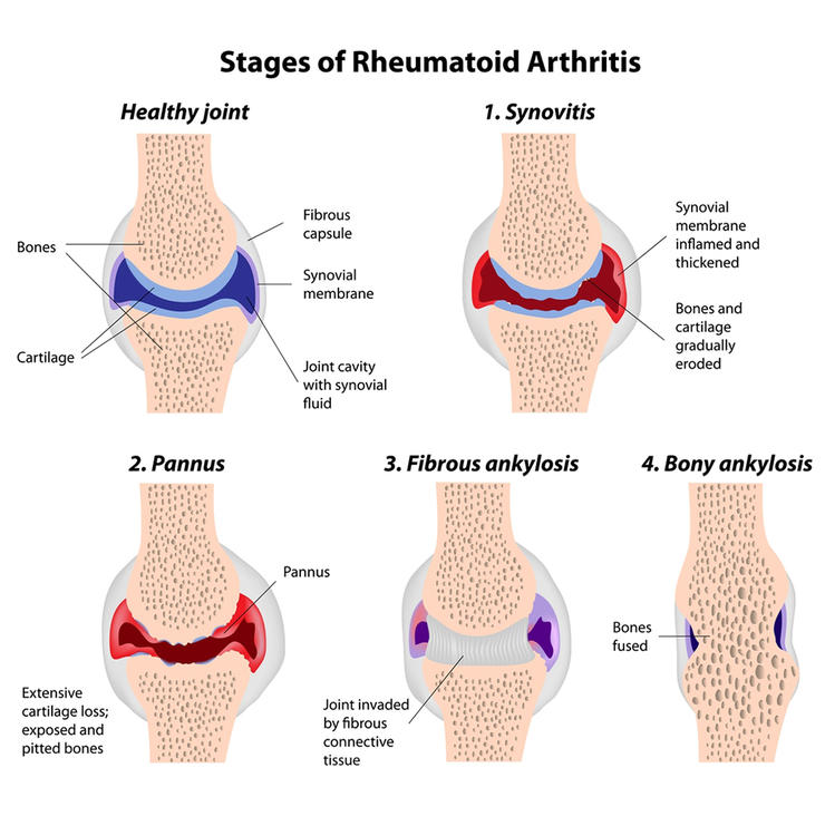 shutterstock 88937434 rheumatoid arthritis alila medical media