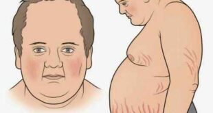 Αύξηση βάρους, διαβήτης, υπέρταση και εύκολη κόπωση ενδέχεται να συνδέονται με νόσο, σύνδρομο Cushing (Cushing’s syndrome)