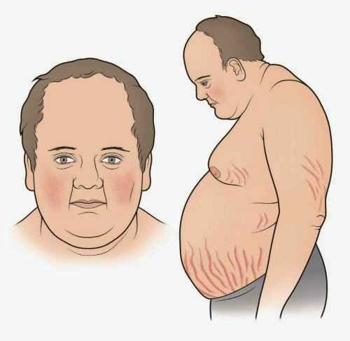 Αύξηση βάρους, διαβήτης, υπέρταση και εύκολη κόπωση ενδέχεται να συνδέονται με νόσο, σύνδρομο Cushing (Cushing’s syndrome)