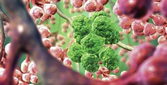 «Ο καρκίνος πιο συχνά οφείλεται σε κακή τύχη παρά σε γενετικές αιτίες»