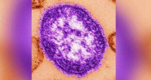 «Επίθεση» ιλαράς στις ΗΠΑ