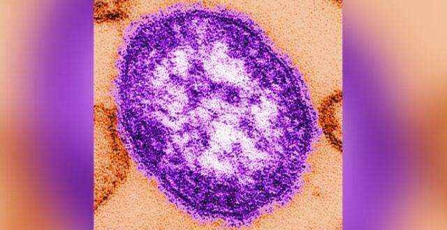 «Επίθεση» ιλαράς στις ΗΠΑ