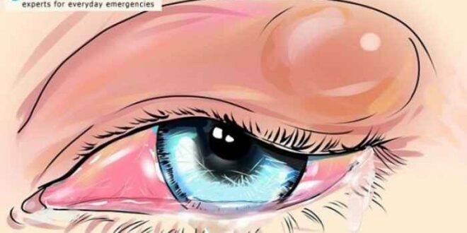 «Κριθαράκι» στο μάτι: Αίτια και αντιμετώπιση