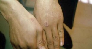 Δακτυλιοειδές κοκκίωμα: Συμπτώματα και αντιμετώπιση