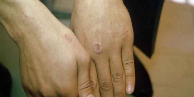 Δακτυλιοειδές κοκκίωμα: Συμπτώματα και αντιμετώπιση