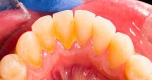 Πλάκα στα δόντια: Πώς θα την απομακρύνετε