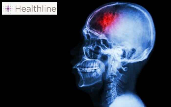 «Μίνι» εγκεφαλικό: Μάθετε τα συμπτώματα!