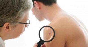 Κρεατοελιές: Όσα πρέπει να γνωρίζετε για την αφαίρεσή τους