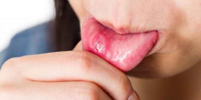 Άφθες στο στόμα: Πώς θα απαλλαγείτε από τις επώδυνες πληγές