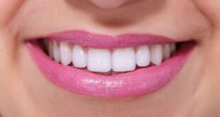Λεύκανση δοντιών: Όσα πρέπει να ξέρετε πριν το αποφασίσετε