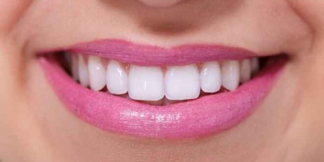 Λεύκανση δοντιών: Όσα πρέπει να ξέρετε πριν το αποφασίσετε