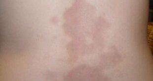 Σκληρόδερμα ή νόσος Morphea του δέρματος: Όσα πρέπει να ξέρετε για την αυτοάνοση ασθένεια