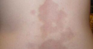 Σκληρόδερμα ή νόσος Morphea του δέρματος: Όσα πρέπει να ξέρετε για την αυτοάνοση ασθένεια