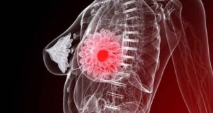 Καρκίνος του μαστού: Είναι δυνατό να ανασταλεί η εξάπλωσή του στα οστά