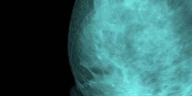 Πυκνότητα μαστών: Δεν αναλογεί πάντα στον κίνδυνο καρκίνου του μαστού