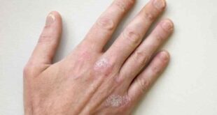 Ψωρίαση στα νύχια: Τα συμπτώματα και πώς αντιμετωπίζεται
