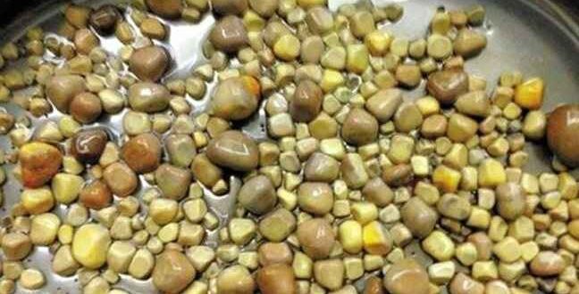 Γιατροί αφαίρεσαν 420 πέτρες από τα νεφρά ασθενή