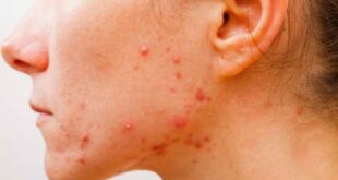 Η βιταμίνη B12 ενισχύει τις πιθανότητες εκδήλωσης ακμής