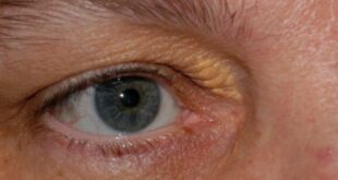 Ξανθέλασμα: Όταν η χοληστερίνη φαίνεται στα μάτια