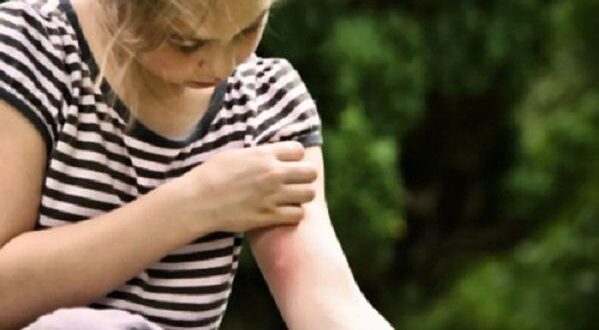 Πολύτιμες συμβουλές για να μην τσιμπήσει το παιδί σας κουνούπι!
