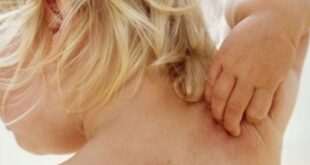Πότε βγάζει δρωτσίλες το παιδί και πώς αντιμετωπίζονται;