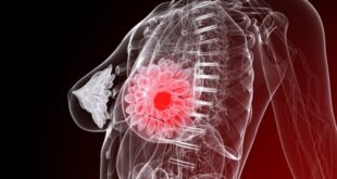 Καρκίνος μαστού: Η αφαίρεση περισσότερου ιστού μειώνει τον κίνδυνο δεύτερης επέμβασης