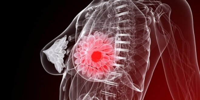 Καρκίνος μαστού: Η αφαίρεση περισσότερου ιστού μειώνει τον κίνδυνο δεύτερης επέμβασης