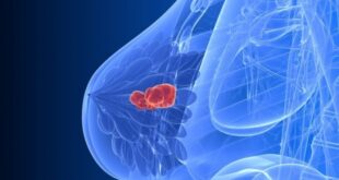 Καρκίνος μαστού: Βρέθηκε η γενετική αιτία επανεμφάνισής του