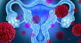 Καρκίνος ωοθηκών: Ποιες γυναίκες κινδυνεύουν περισσότερο και ποιες λιγότερο