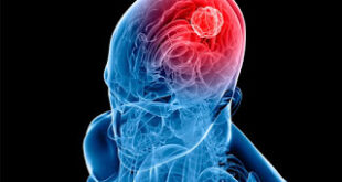 Το αυξημένο βάρος συνδέεται με αυξημένο κίνδυνο εμφάνισης όγκου στον εγκέφαλο
