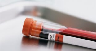 Τεστ αίματος για τη διάγνωση του καρκίνου του προστάτη