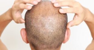 Γυροειδής αλωπεκία: Όταν η απώλεια μαλλιών οφείλεται σε αυτοάνοσο - Ποιες λύσεις υπάρχουν