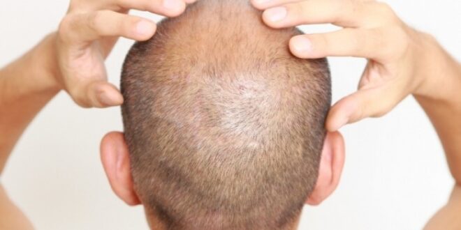 Γυροειδής αλωπεκία: Όταν η απώλεια μαλλιών οφείλεται σε αυτοάνοσο - Ποιες λύσεις υπάρχουν