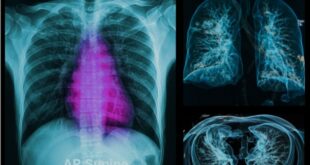 Εξετάσεις με ακτινοβολία: Πόσο αυξάνονται οι πιθανότητες καρκίνου