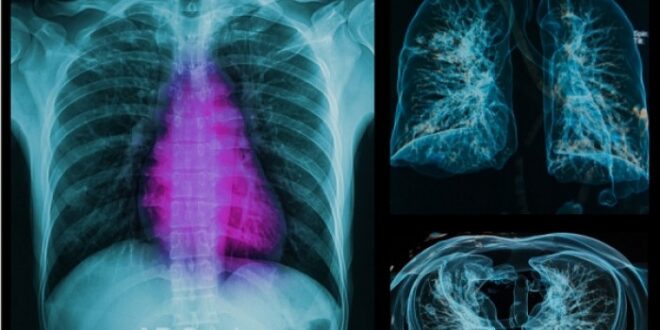 Εξετάσεις με ακτινοβολία: Πόσο αυξάνονται οι πιθανότητες καρκίνου