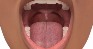 Σιαλολιθίαση: Η επίπονη πάθηση του στόματος - Ποια είναι τα συμπτώματα