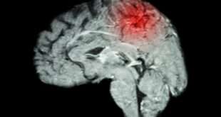 Επιθεώρηση Stroke: Όσοι παραλείπουν αυτό το γεύμα, κινδυνεύουν από εγκεφαλικό