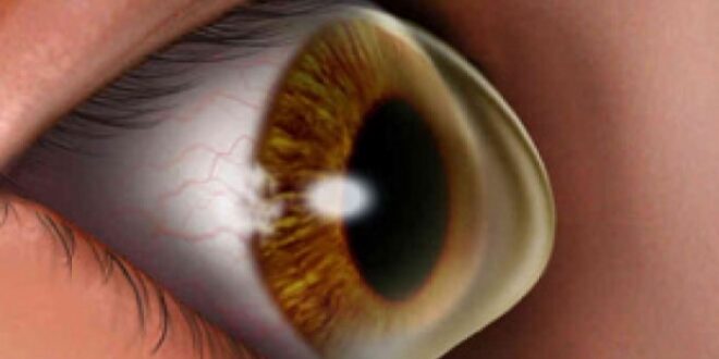 Κερατόκωνος: Ποιοι κινδυνεύουν περισσότερο από την οφθαλμική διαταραχή