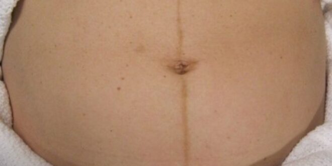 Πού οφείλεται η μαύρη γραμμή που παρατηρείται στην κοιλιά μιας εγκύου;