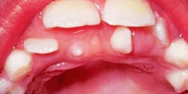 Υπεράριθμα δόντια στα παιδιά: Υπάρχει τρόπος αντιμετώπισης;
