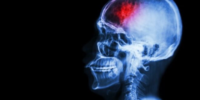 Εγκεφαλικό: Ποιος είναι ο παράγοντας που διπλασιάζει τον κίνδυνο