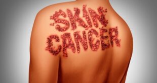 Ελιές στο δέρμα & καρκίνος: Νέα έρευνα ανατρέπει όσα ξέραμε!