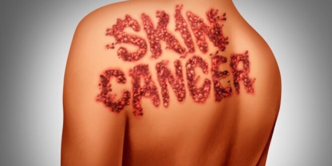 Ελιές στο δέρμα & καρκίνος: Νέα έρευνα ανατρέπει όσα ξέραμε!