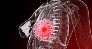 Νέοι δρόμοι στη θεραπεία του καρκίνου του μαστού χάρη σε νεαρό Έλληνα ερευνητή